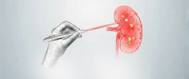 Laser Treatment for Kidney Stones in Dubai: How It Works & What to Expect