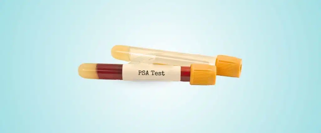 Understanding PSA Testing and Prostate Cancer Screening Methods