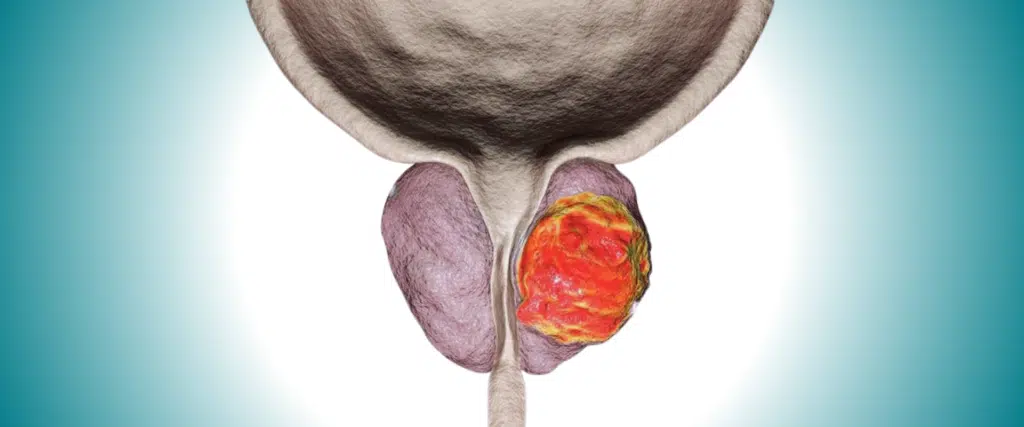 What Prostate Cancer Is and How It Develops