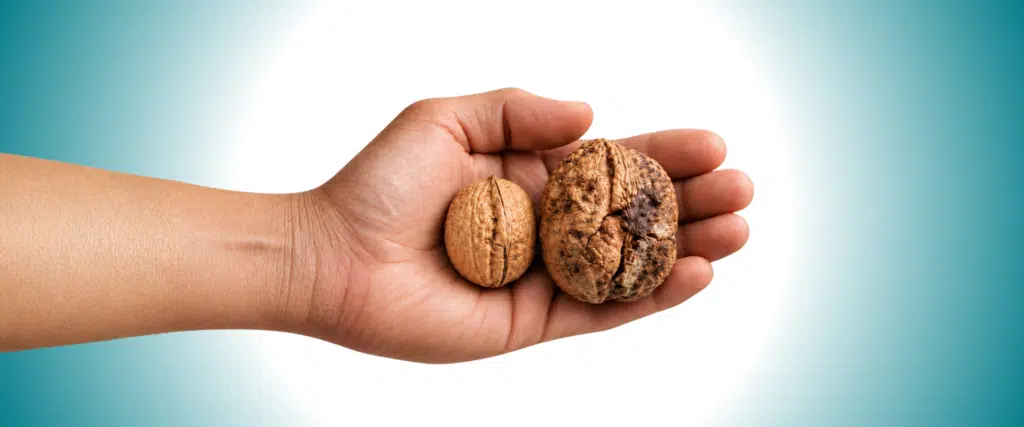 Testicular Cancer: What Every Man Needs to Know